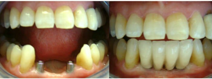 Dental Implants Before and After source: Beckhenham Dentist